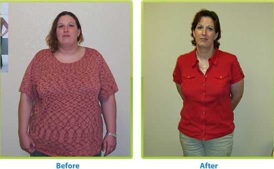 bariatric surgery, gastric bypass