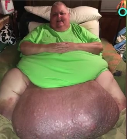 Man Was Told He Was 'Just Fat' - But It Was Actually A 130-pound Abdominal Tumor