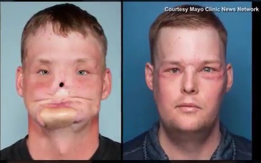 Face Transplant Exceeds Guy's Expectations Ten Years After Tragedy