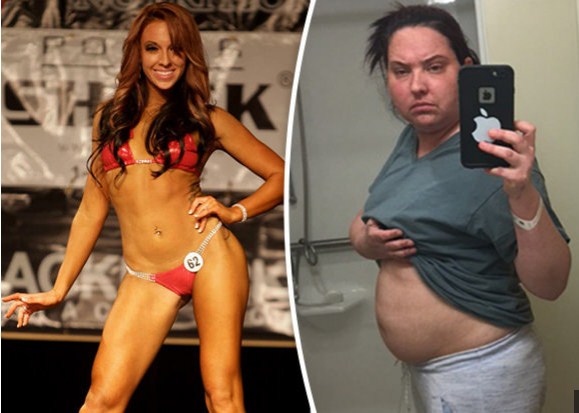 Bikini Fitness Modeal Reveals How Her Weight Gain Was Caused By Brain Tumor