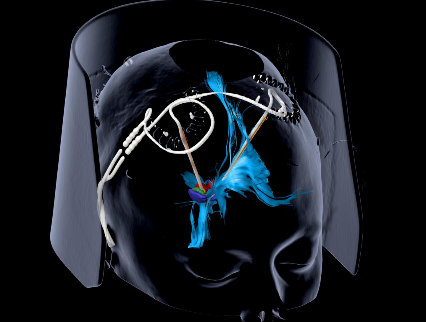 Deep Brain Stimulation Provides Sustained Relief for Severe Depression (IMAGE)