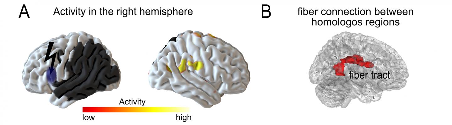Activity in the Right Hemisphere after a Second Lesion on the Left Side
