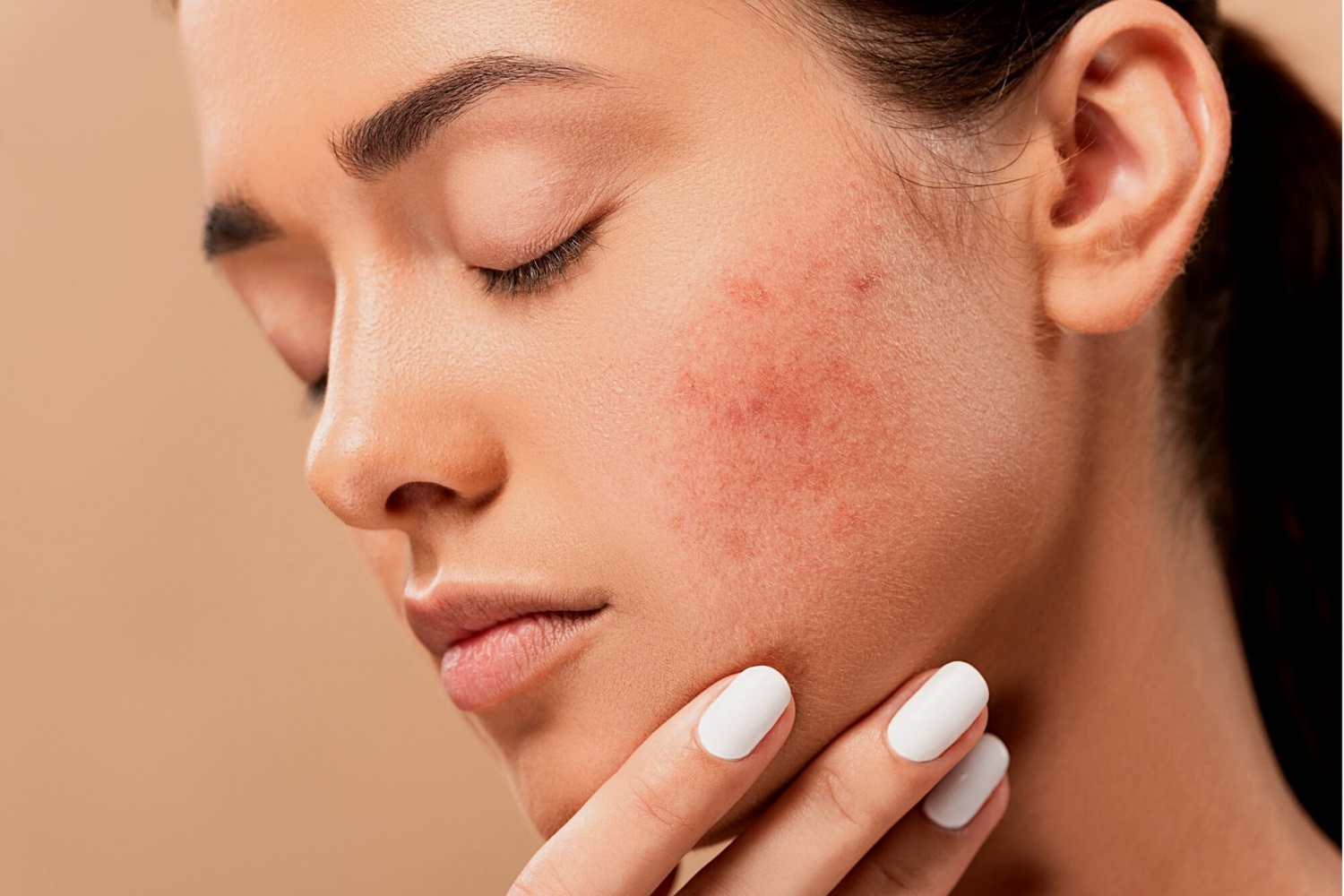 UAE Blog 9: Is Homeopathic Treatment Useful for Acne?