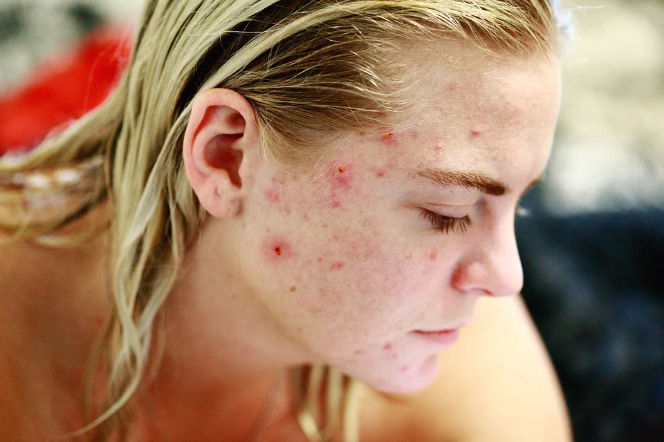 Worried about your acne? When is it time to see a dermatologist?