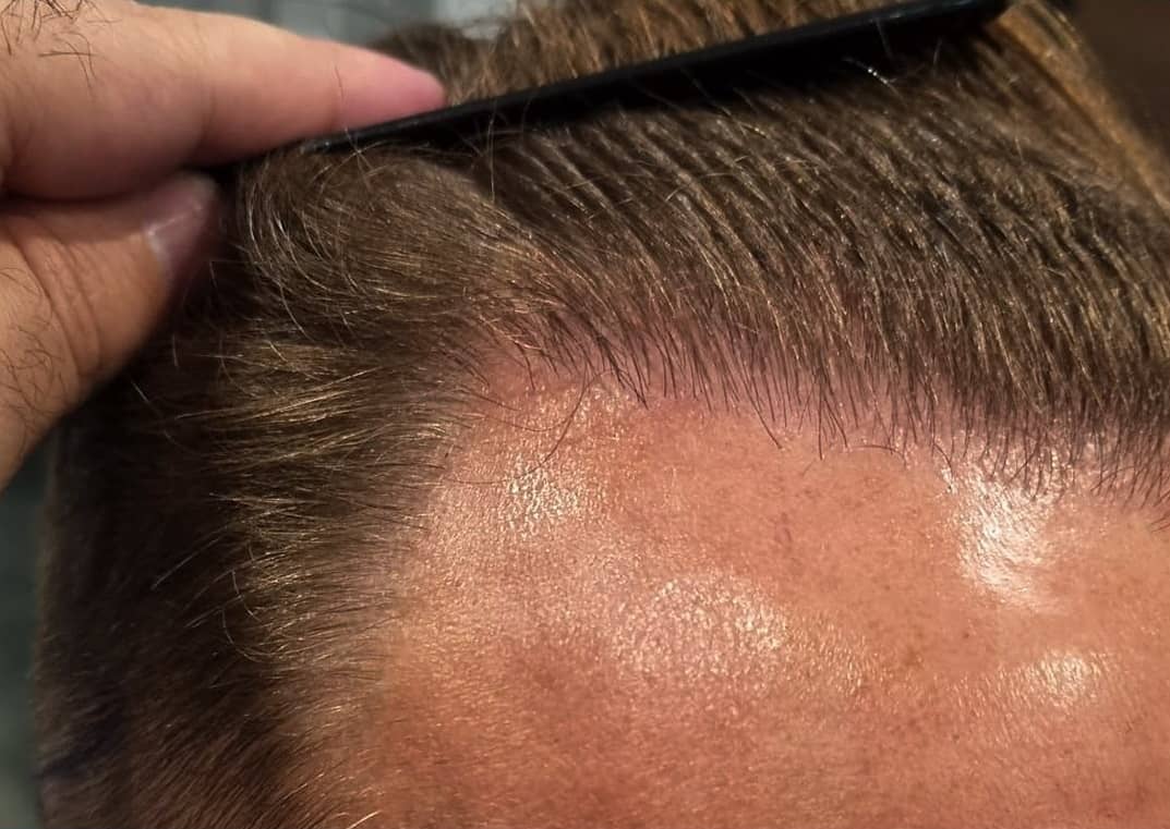 Hair Transplant Turkey Before and After Results