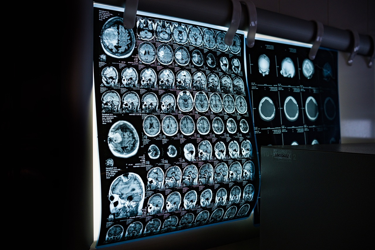 brain scan for aneurysm