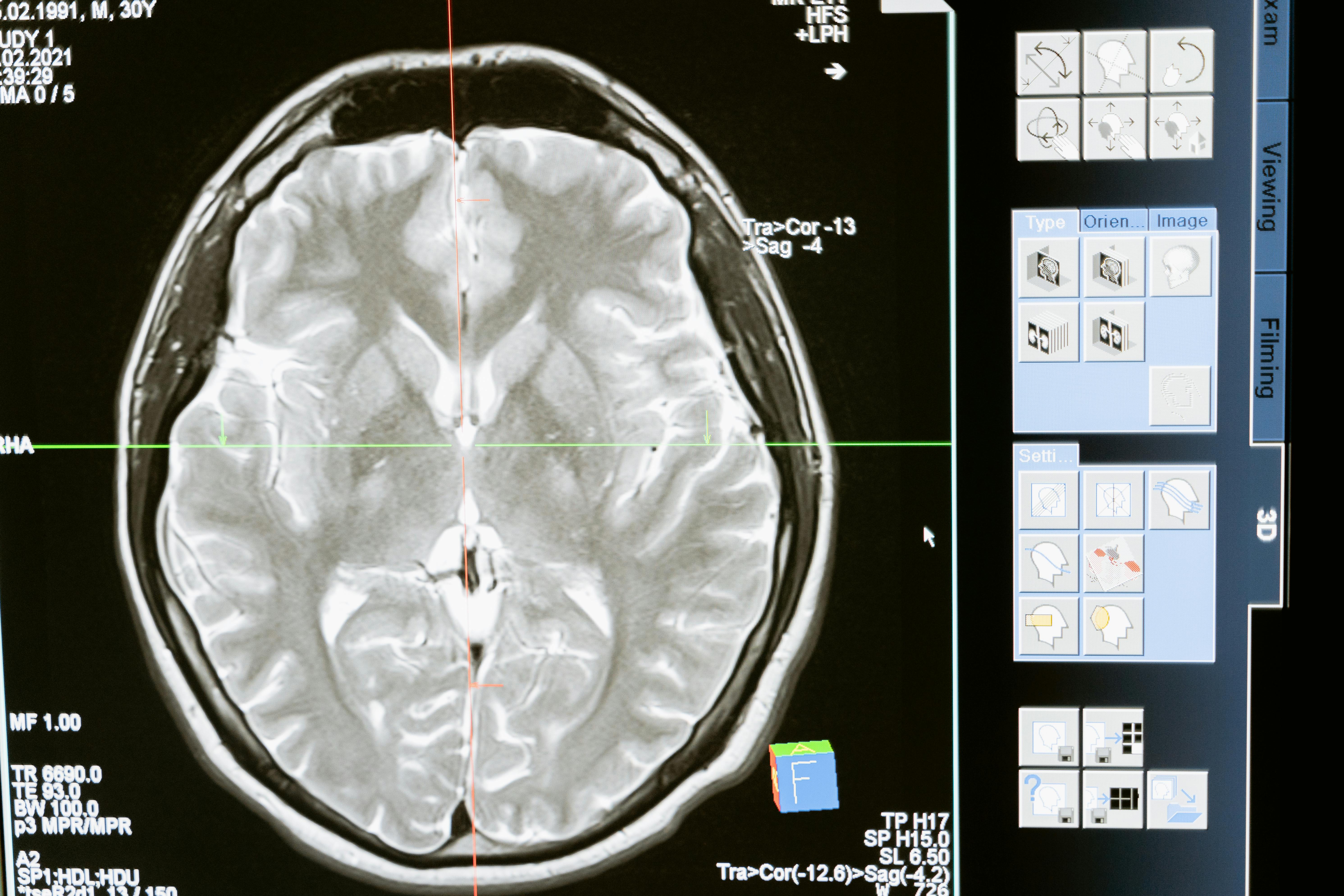 brain injury scan for light therapy