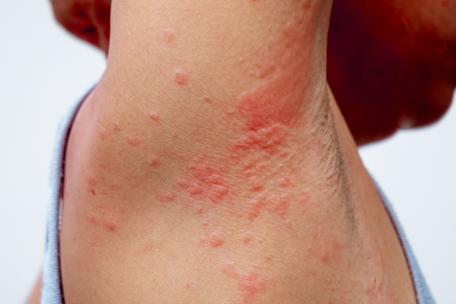 What Triggers Psoriasis