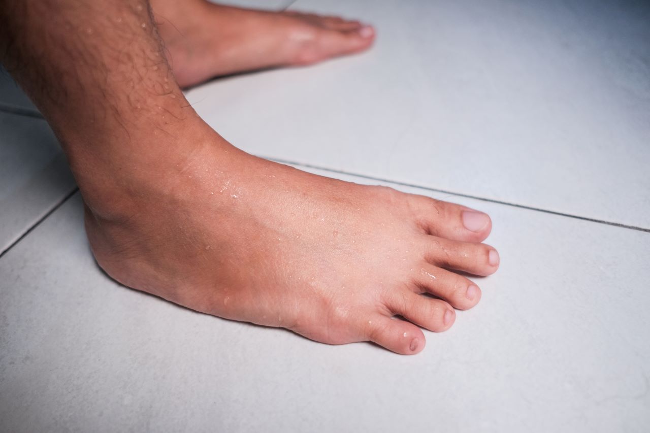 Causes of Swollen Feet